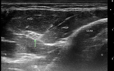 Clinical and Ultrasonographic Features of Distal Ulnar Neuropathy: A Review